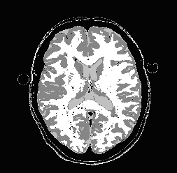 Max 2D Posterior Brain Segmentation