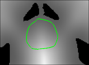 Prostate slice viewed axially in an image of distance to bone