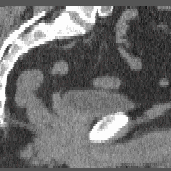 Bladder surface colored according to intensity distribution type