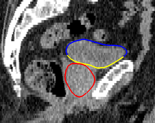 Bladder contour colored according to intensity distribution type
