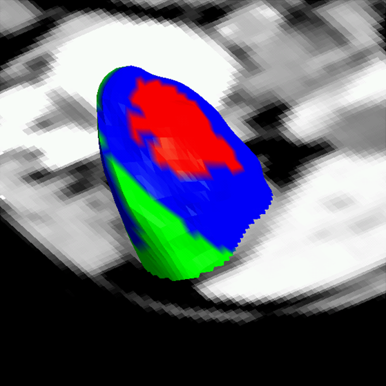 Kidney surface colored according to intensity profile type