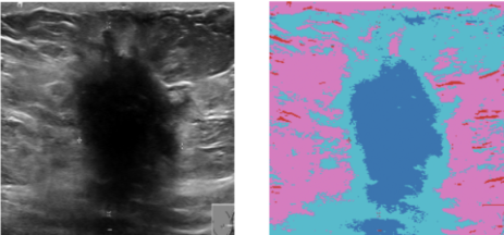 Breast ultrasound with a synthetic tumor and tissue map