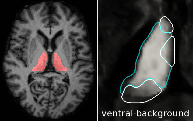 Example brain MRI with thalamus highlight, and ventral nucleus score image