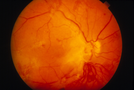 Fundus image used to diagnose diabetic retinopathy