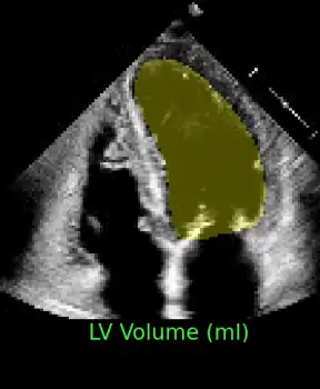 Automatic left-ventricle segmentation in echocardiography, with the LV volume traced over several heartbeats