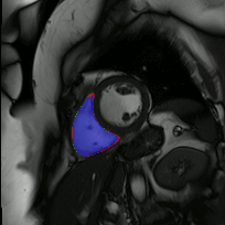 Right ventricle segmentation from CMR. blue:intersection green:automatic, red:manual.